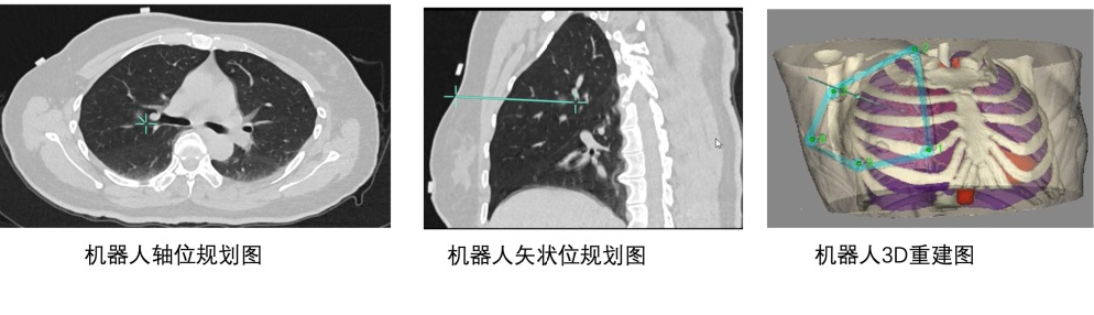 临床风采｜真易达穿刺手术机器人辅助下特殊部位早期小肺癌经皮肺穿刺消融应用案例