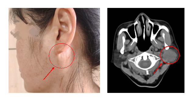 攻克高危禁区！武汉大学中南医院口腔医学中心成功为「带支架」患者切除腮腺肿瘤