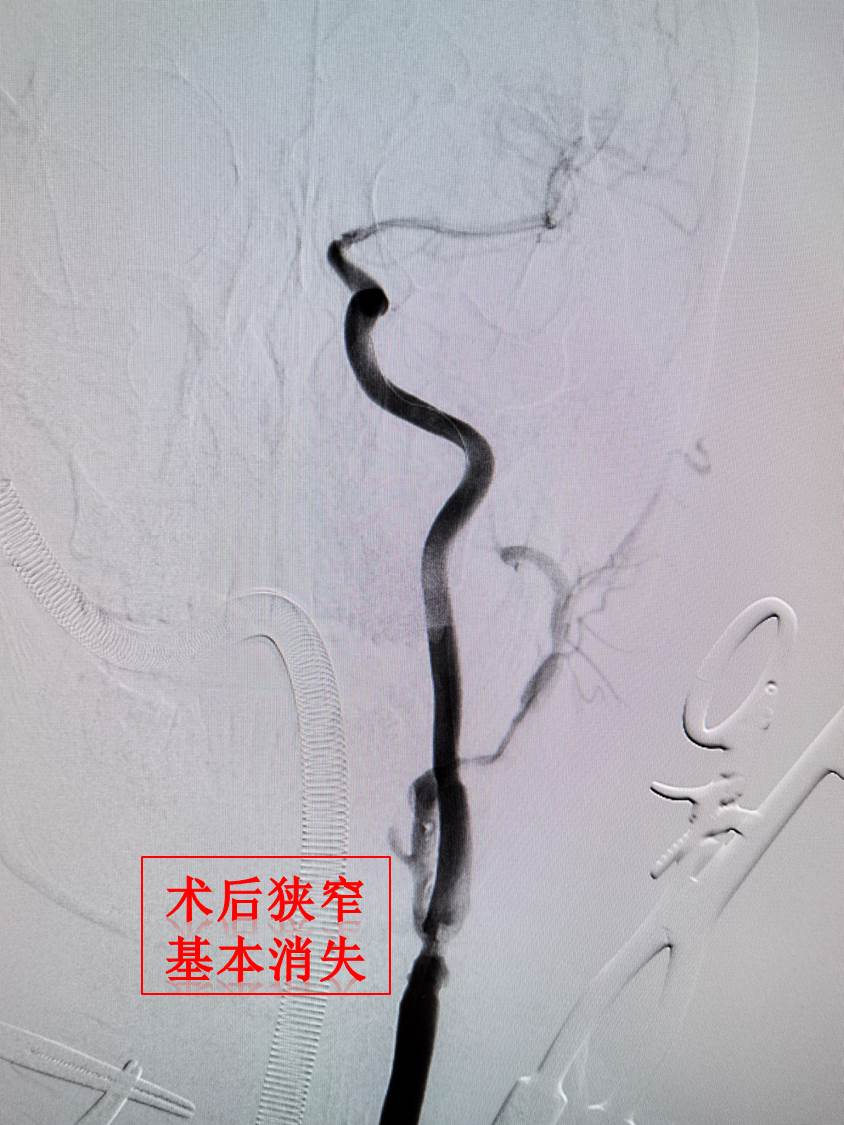 西安交大一附院成功开展西北首例经颈逆血流颈动脉狭窄血运重建(TCAR)术