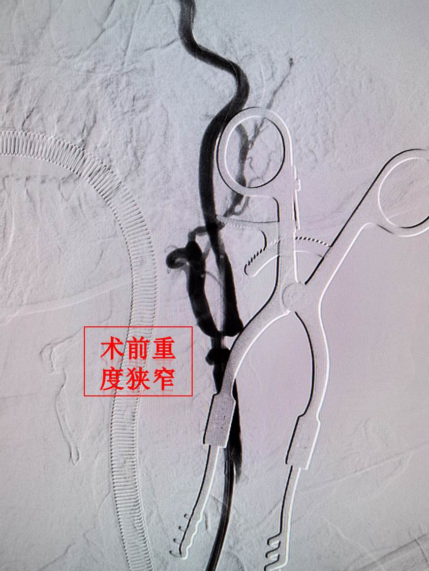 西安交大一附院成功开展西北首例经颈逆血流颈动脉狭窄血运重建(TCAR)术