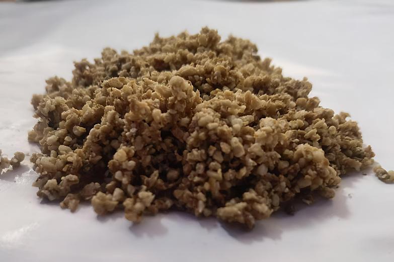 女子双肾「鹿角状」结石足有拳头大!武大人民医院 5 期手术打赢「巨石攻坚战」