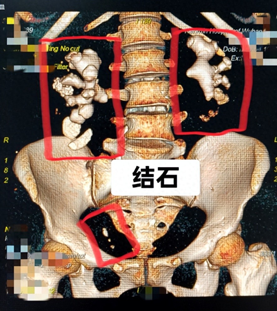 女子双肾「鹿角状」结石足有拳头大!武大人民医院 5 期手术打赢「巨石攻坚战」