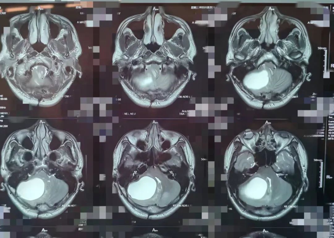 神经外二科完成新院区首台手术,深耕神经领域 11 载,再启发展新篇章