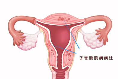 痛经与子宫腺肌病，背后的健康隐患