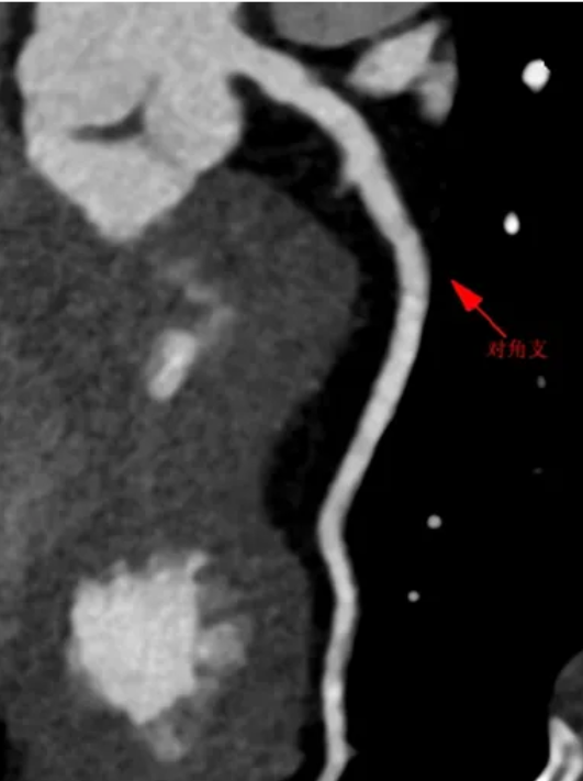 从反复胸闷到心梗预警：一例冠心病患者的规范诊疗之路