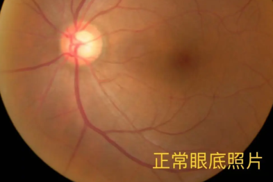 不让高度近视人士献血，其实是一种保护