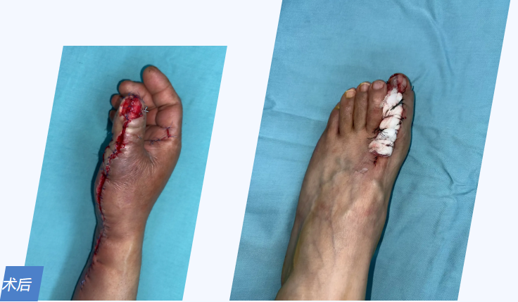 足趾「巧补」手断指重生！手足外科成功完成高难度拇指全形再造术
