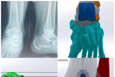 3D 打印个体化假体助力终末期踝关节患者「踝」然新生