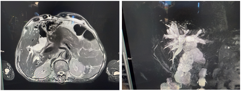 高龄老人饱受肝胆内外结石折磨十余年，多学科联手成功破解顽疾