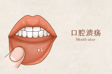 口腔里的不速之客——口腔溃疡