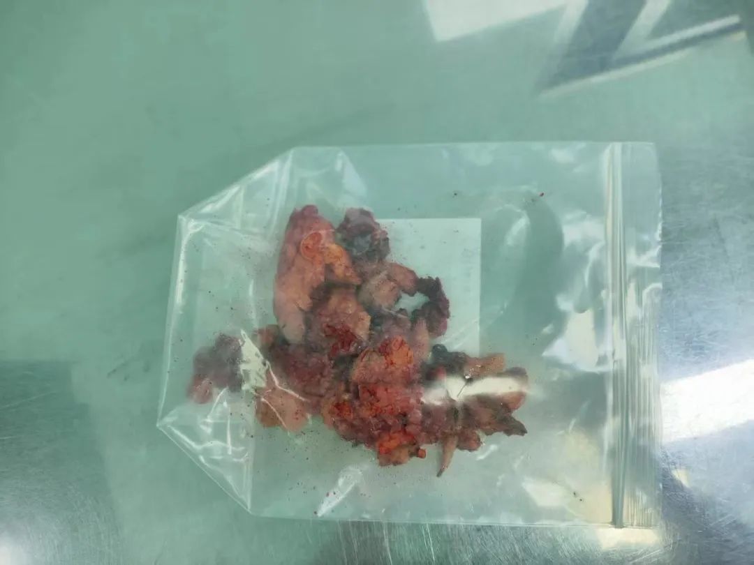 剧痛难忍！漳州 39 岁女子遭遇「人体组织粉碎机」，严重可致命！