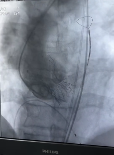 湖州市中心医院心脏瓣膜团队单日完成 3 例高难度手术