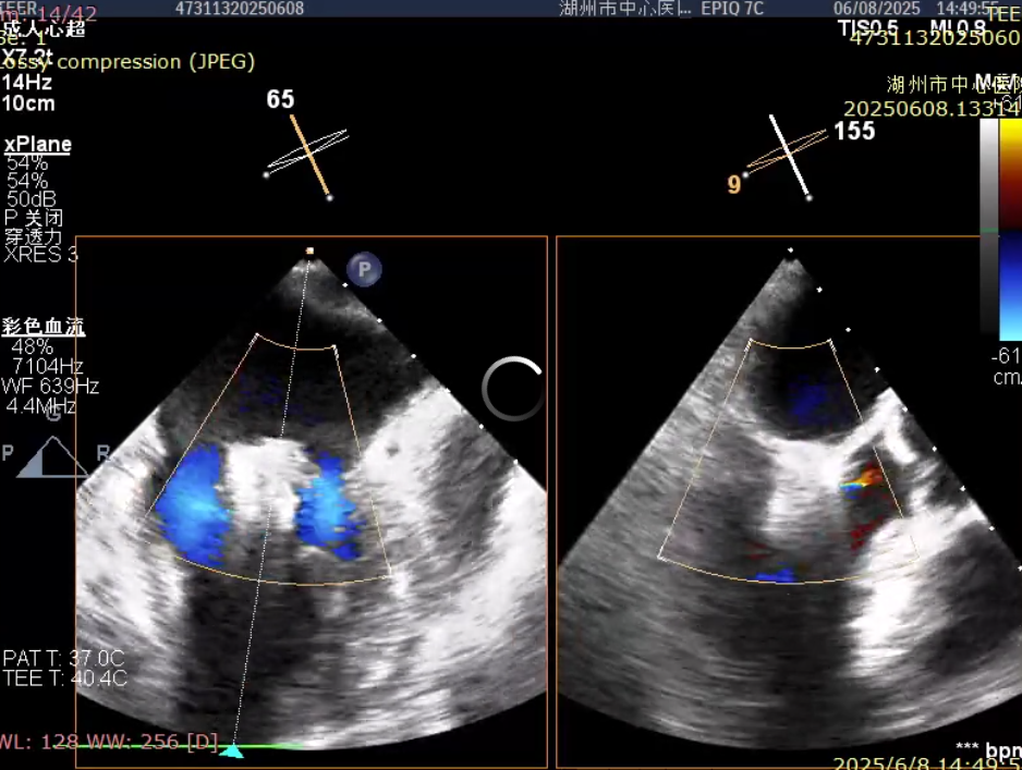 湖州市中心医院心脏瓣膜团队单日完成 3 例高难度手术