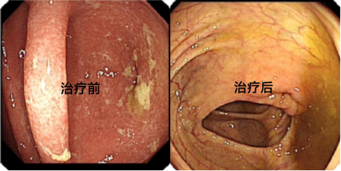 总是跑厕所 大便不成型？警惕肠溃疡！