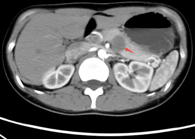南方科技大学医院:成功实施突破性胰腺肿瘤手术助力患者重获新生