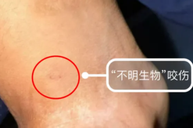 校园突发银环蛇咬伤，湘潭市一医院黄金 1 小时救治跑赢「呼吸麻痹」