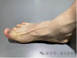 专家说｜孙宁主任教你：𧿹外翻术前康复训练，常做的 4 个动作！