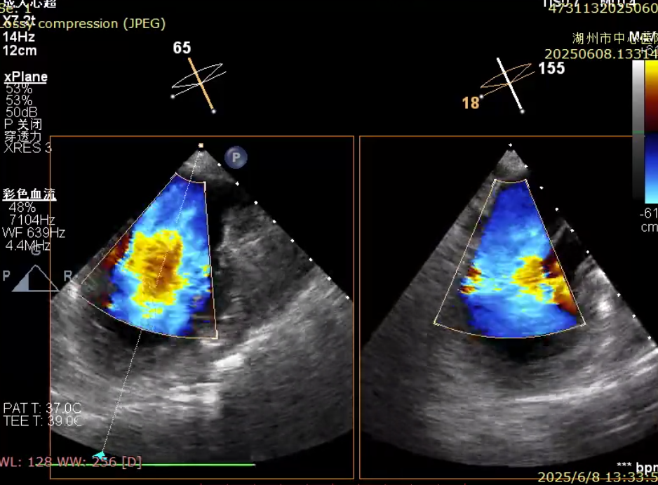 湖州市中心医院心脏瓣膜团队单日完成 3 例高难度手术