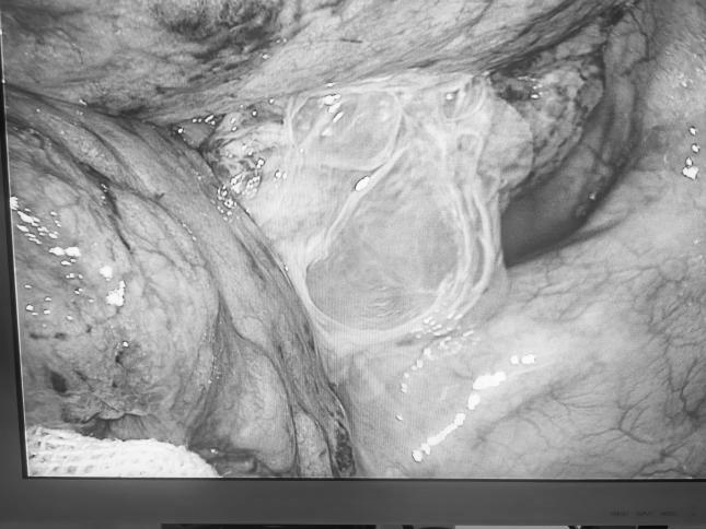 突破高龄「禁区」 | 桂医二附院单孔胸腔镜手术让 85 岁老人告别插胸管生活