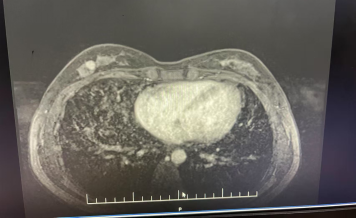 乳腺癌必须全切？陈雷医生：这类患者 90% 可保乳