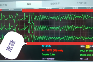 合肥一男子酒后喊痛 手术台上心脏停跳 5 次！合肥京东方医院紧急救援
