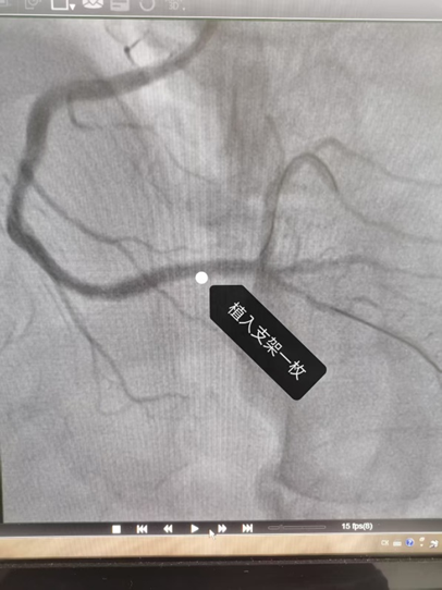 合肥一男子酒后喊痛 手术台上心脏停跳 5 次！合肥京东方医院紧急救援