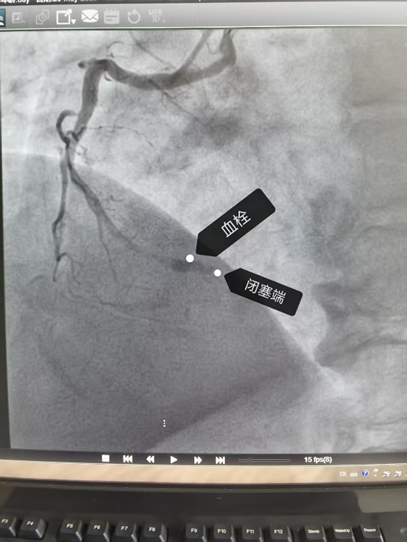 合肥一男子酒后喊痛 手术台上心脏停跳 5 次！合肥京东方医院紧急救援