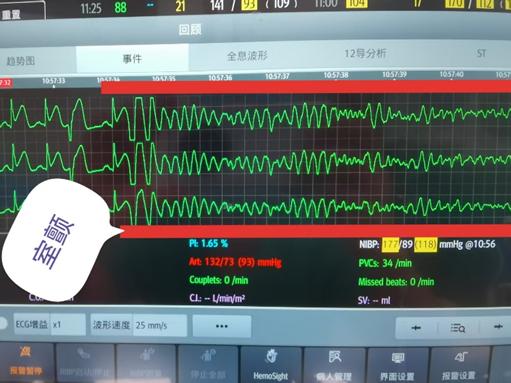 合肥一男子酒后喊痛 手术台上心脏停跳 5 次！合肥京东方医院紧急救援