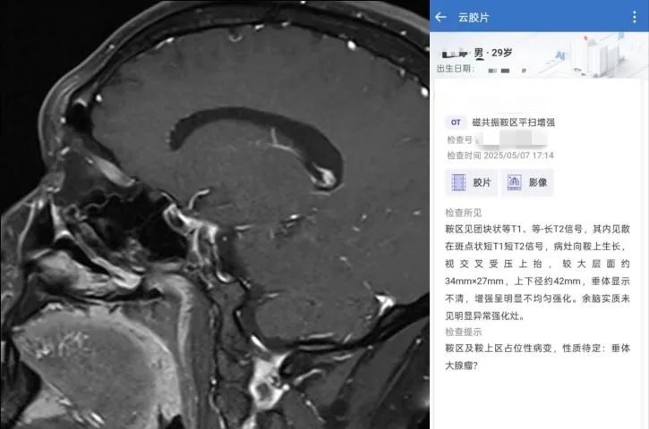 男科检查竟发现脑瘤?论性激素检查的重要性