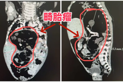 6 月龄女婴身「藏」17 cm 巨大畸胎瘤！江西省儿童医院多学科团队手术「拆除」