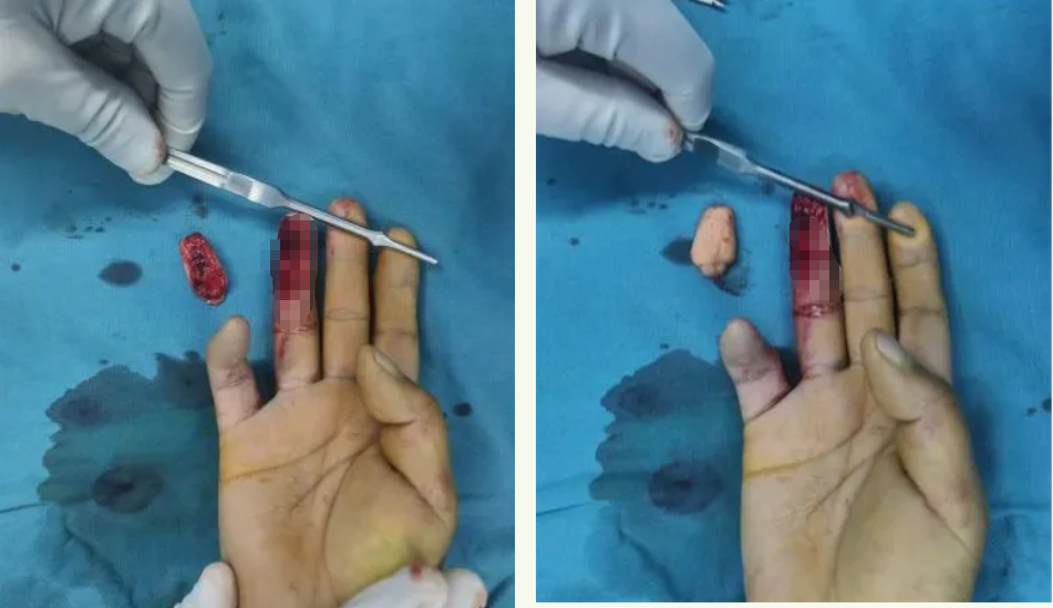 组织块离断再植,延安市中医医院为患者重铸手指