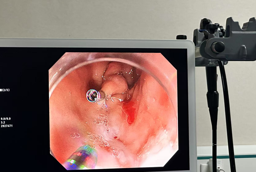 【卓越阳光】生死竞速!消化儿科联手用内镜 "缝补" 患儿出血消化道