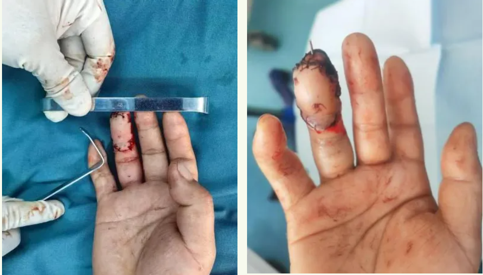 组织块离断再植,延安市中医医院为患者重铸手指