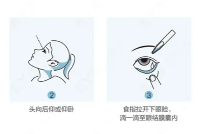医生眼里，近视手术后伤眼的 5 种行为