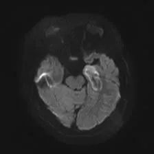 术中核磁手术室正式启用，助力激光间质消融手术治癫痫