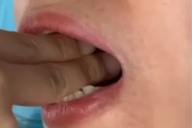 一张嘴就痛？告别咬牙硬抗，颞下颌紊乱病这样治更有效！