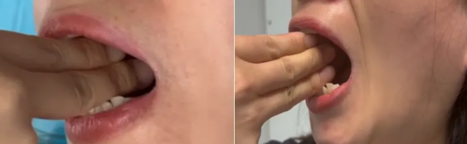 一张嘴就痛？告别咬牙硬抗，颞下颌紊乱病这样治更有效！