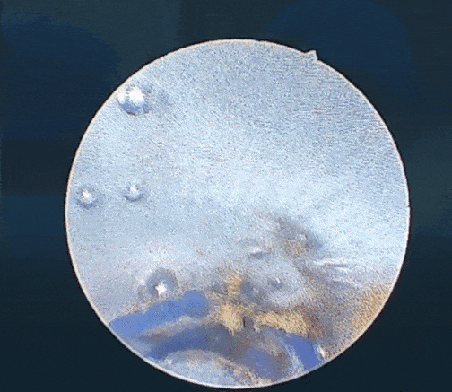 硬质胆道镜「拆线取石」,桂医大二附院破解胆肠吻合口狭窄顽疾