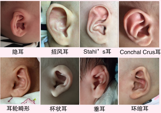 新生儿耳朵"长歪了"怎么办?合肥京东方医院提醒:盲目"捋耳朵"风险大,矫正黄金期别错过