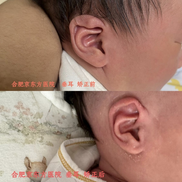 新生儿耳朵"长歪了"怎么办?合肥京东方医院提醒:盲目"捋耳朵"风险大,矫正黄金期别错过