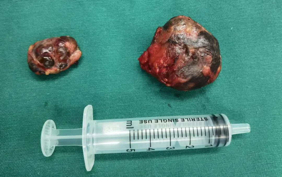 颈部无痛包块暗藏致命危机！这场 「拆弹手术」 险象环生