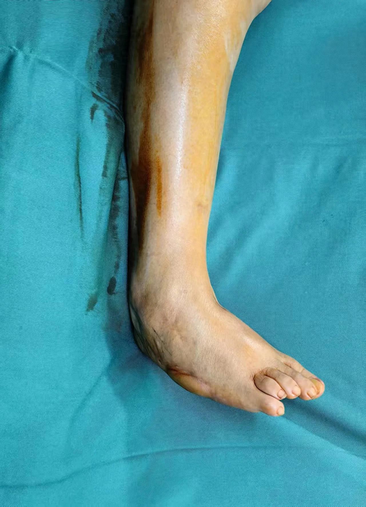 「跛」了 60 年「歪脚」，武大人民医院一朝「掰」正