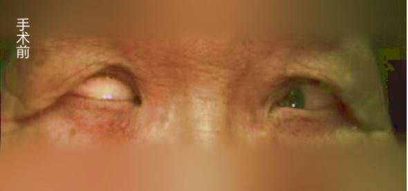 创新术式助双眼「改斜归正」 ！武大人民医院眼科专家破解高度近视性固定性内斜视顽疾