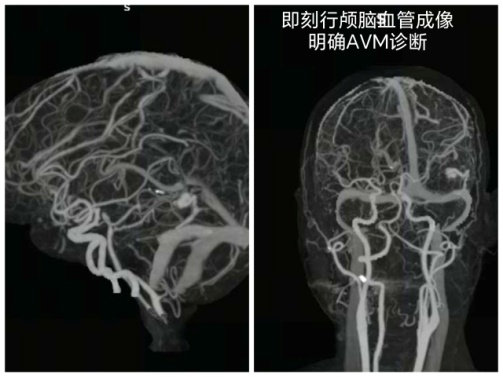 57 岁大叔脑动静脉破裂出血！深圳医生极速「拆弹」