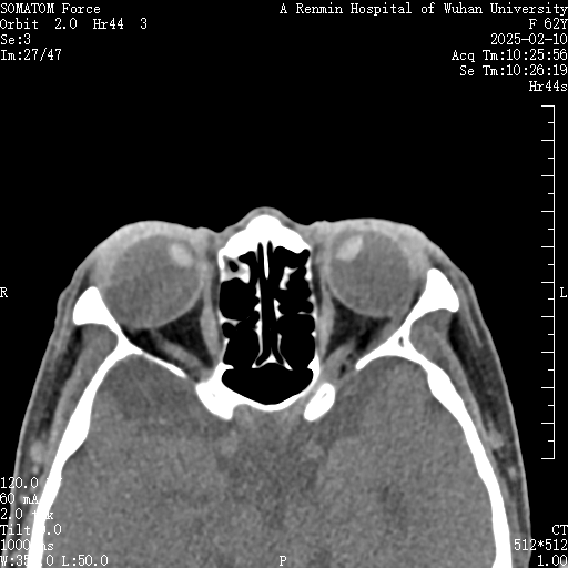 创新术式助双眼「改斜归正」 ！武大人民医院眼科专家破解高度近视性固定性内斜视顽疾