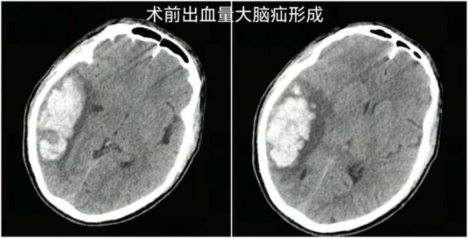 57 岁大叔脑动静脉破裂出血！深圳医生极速「拆弹」