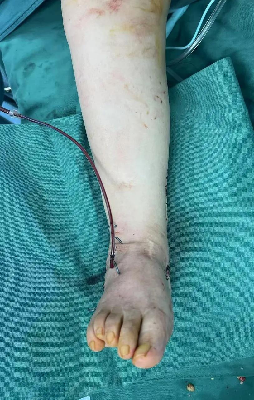 「跛」了 60 年「歪脚」，武大人民医院一朝「掰」正