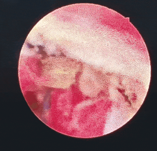 硬质胆道镜「拆线取石」,桂医大二附院破解胆肠吻合口狭窄顽疾