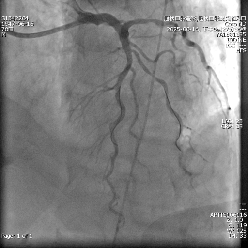 攻坚「钙化堡垒」！湖北省三院阳逻院区成功实施高难度冠脉手术，为七旬老人重铸「心」路