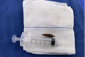 枣核卡喉有多危险?中大医院专家教你三步救命法